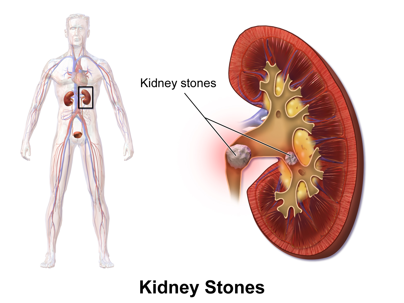 Kidney stones