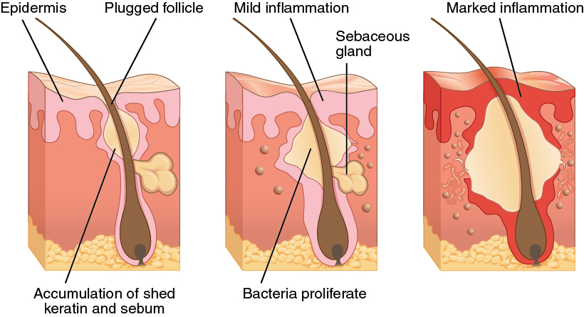 Rid Yourself Of Pimples By Simply Following These Suggestions