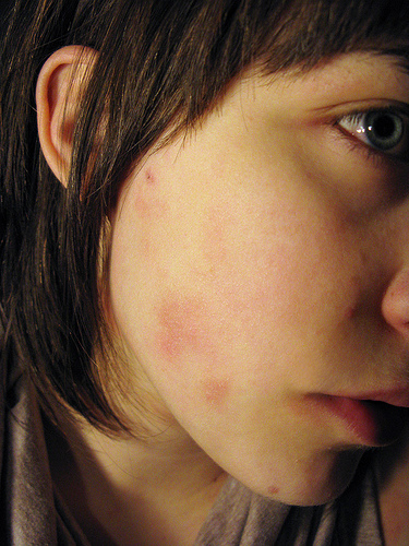 How To Get Rid Of Your Bothersome Pimples