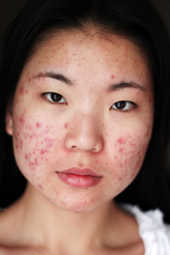 Coping With Troublesome Acne Issues