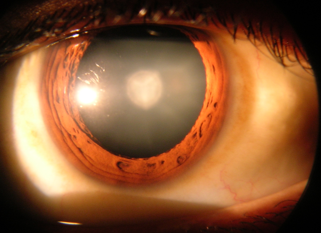 Dealing with Cataract