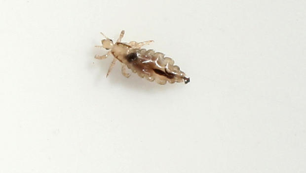 Head lice are evolving tougher, harder to zap
