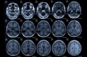 LSD reorganize human brain networks and changes consciousness