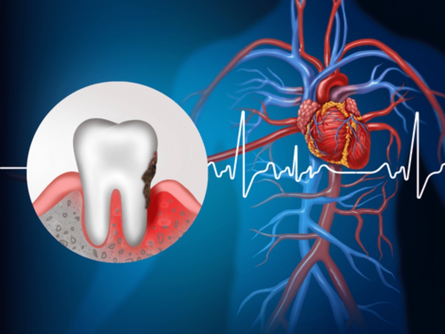 Gum infection may be a risk factor for heart arrhythmia, researchers find