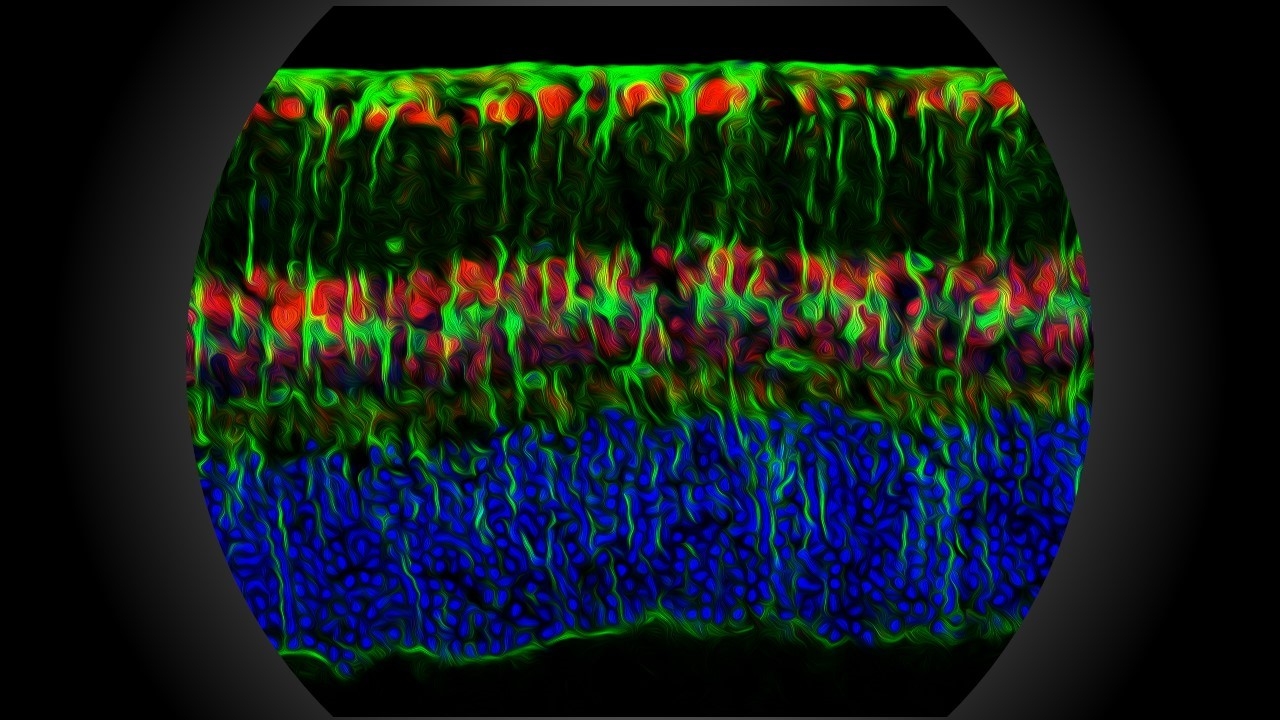 Researchers Unravel Why Episodes of Low Blood Sugar Worsen Eye Disease in People with Diabetes