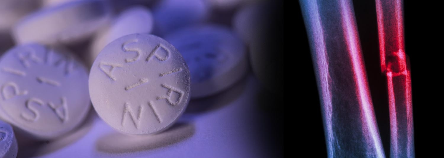 Aspirin as Effective as Blood Thinner Injections to Prevent Deadly Complications in Patients Hospitalized with Bone Fractures