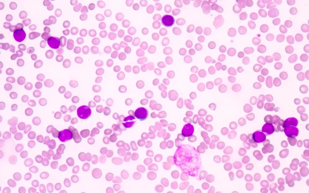 New promising targeted drug for a rare leukemia
