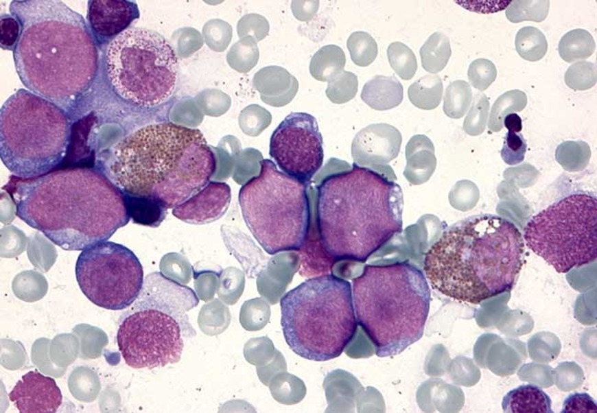 Cause of leukaemia in trisomy 21