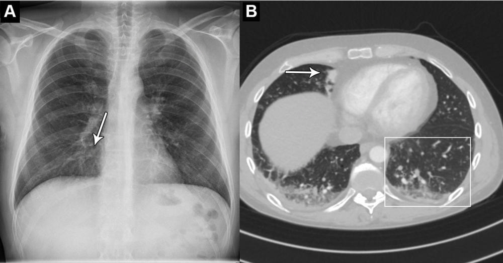 AI Accurately Identifies Normal and Abnormal Chest X-rays