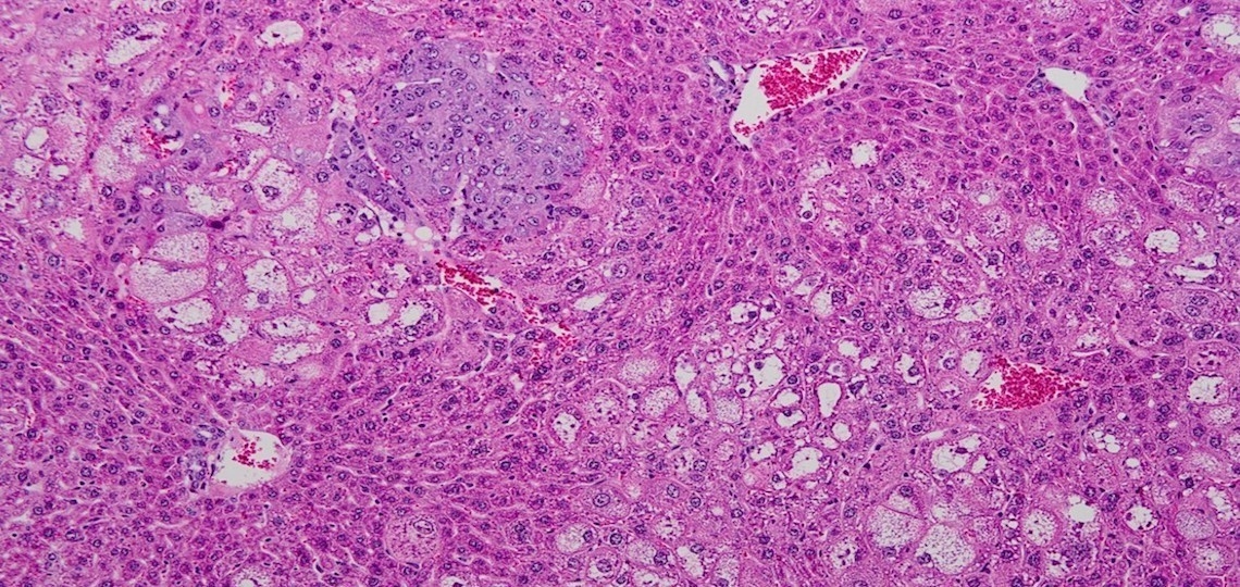 Gene therapy study identifies potential new treatment for liver cancer