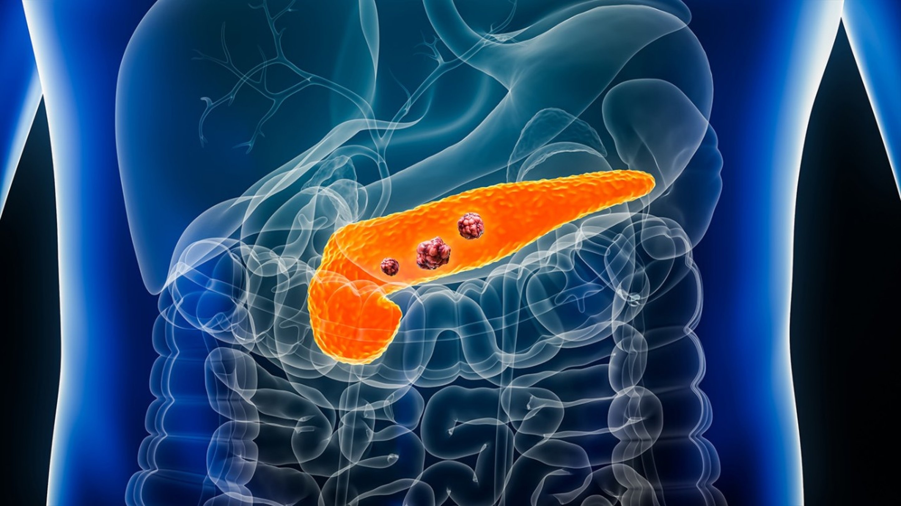 Combining immunotherapy with KRAS inhibitor eliminates advanced KRAS-mutant pancreatic cancer in preclinical models