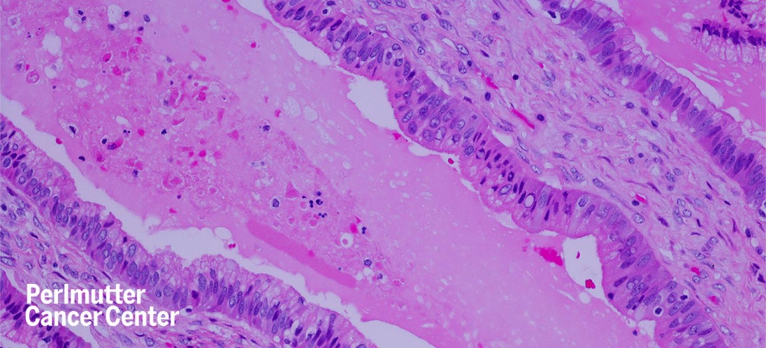 Newfound Mechanism Suggests Drug Combination Could Starve Pancreatic Cancer