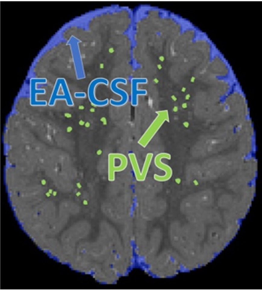 Enlarged Spaces in Infant Brains Linked to Higher Risk of Autism, Sleep Problems