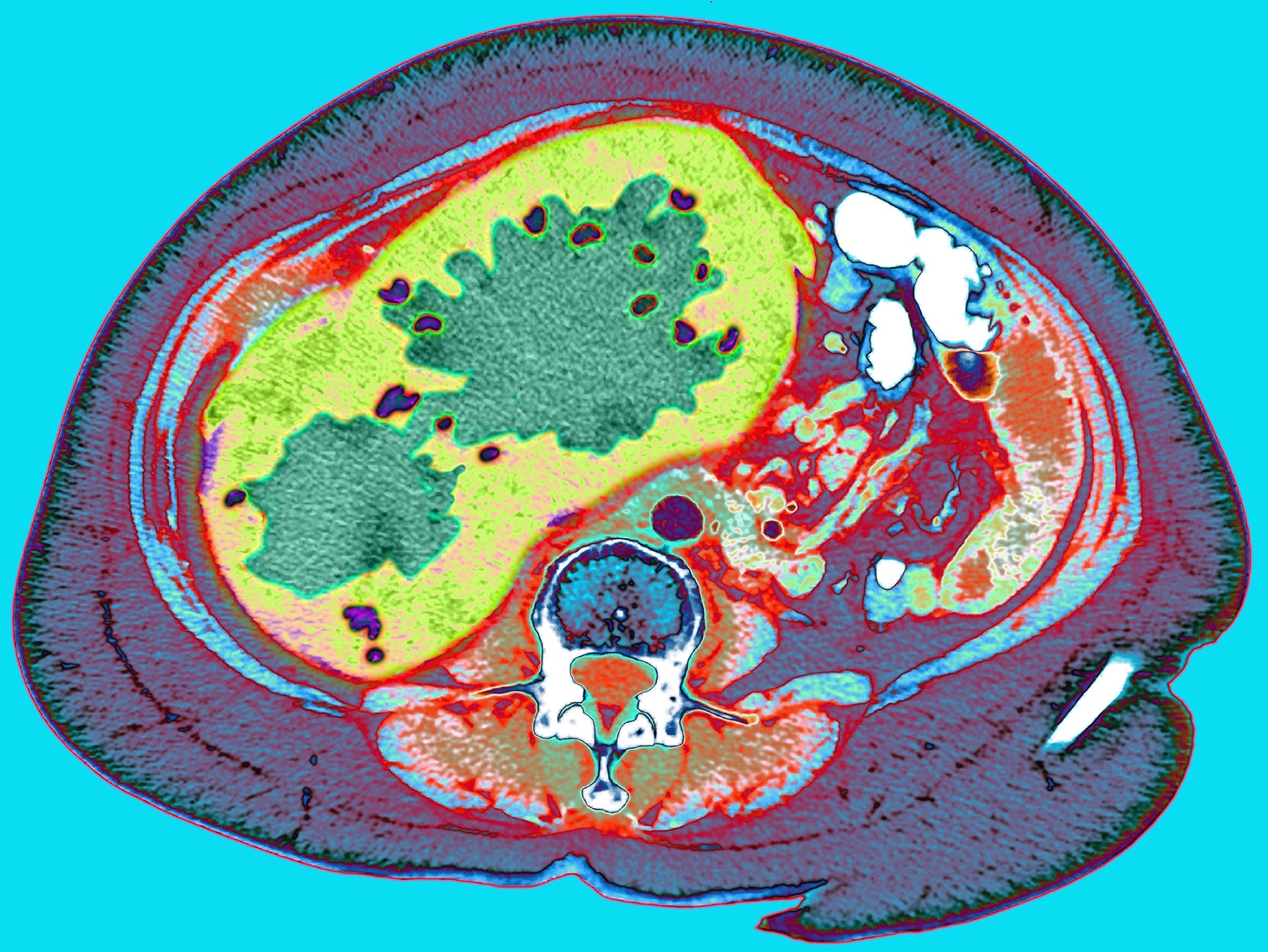 A pioneering way to target the culprit behind a deadly liver cancer