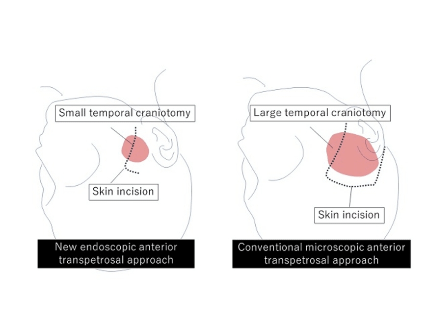 Safer, swifter, smaller scar: new brain surgery approach targets difficult tumors at skull base