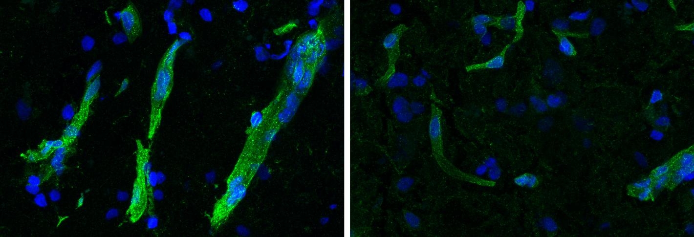 Movement disorder ALS and cognitive disorder FTLD show strong molecular overlaps, new study shows
