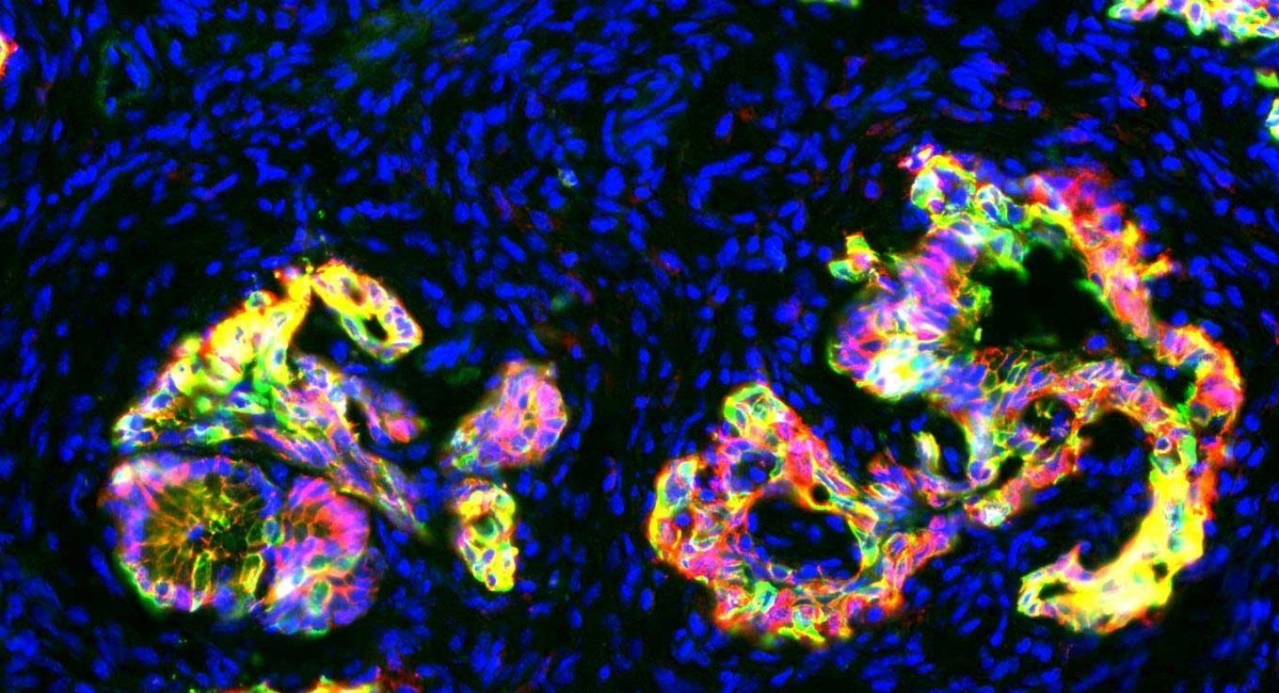 Can a New Drug Candidate Cure Pancreatic Cancer?