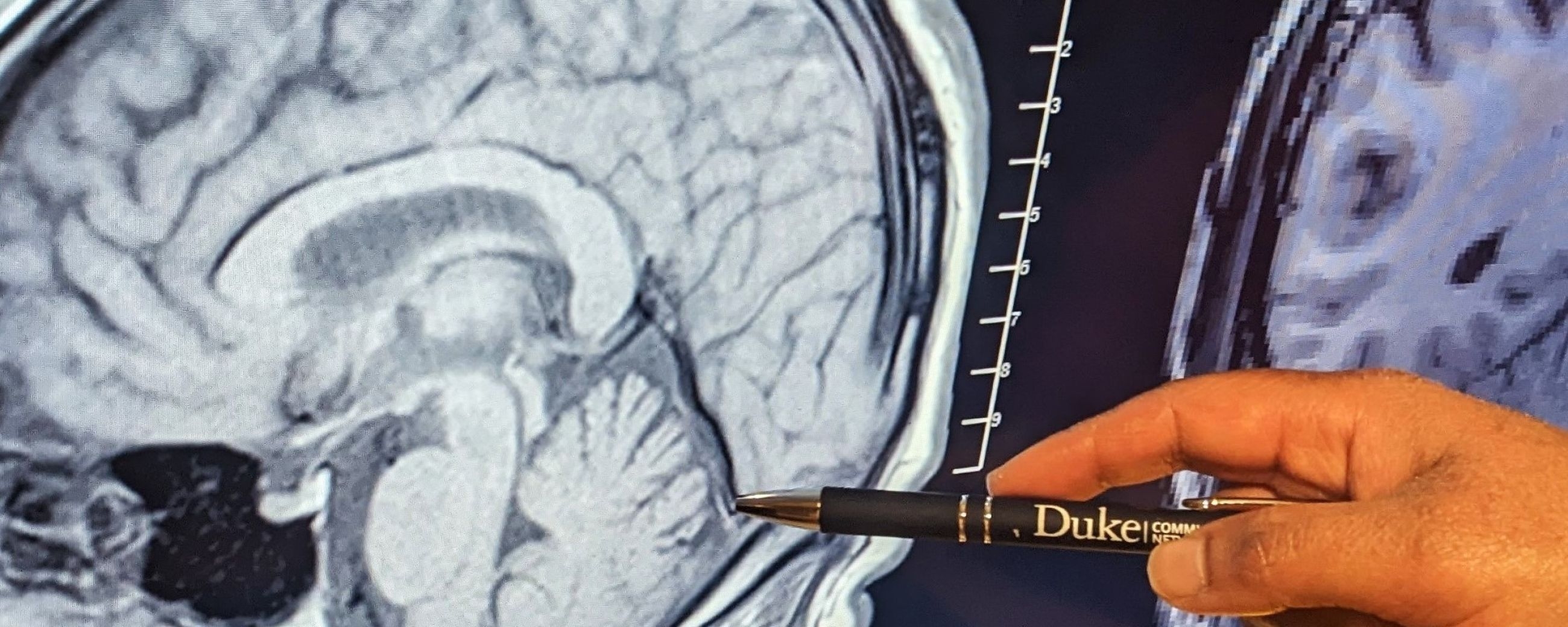 Traumatic Stress Associated With Smaller Brain Region