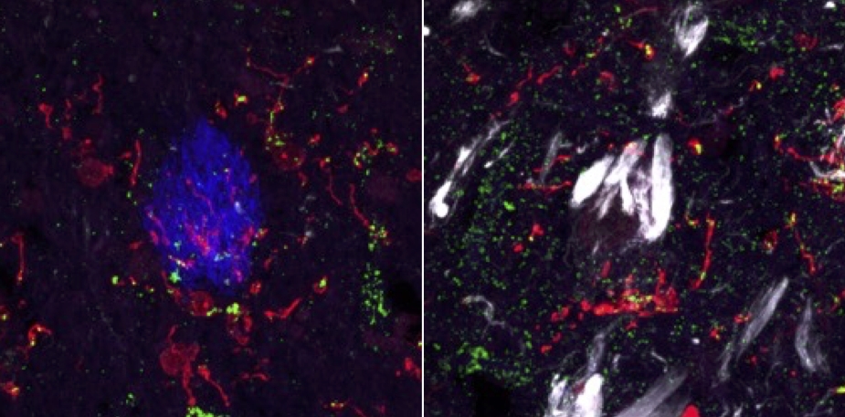 Marker for brain inflammation finally decoded