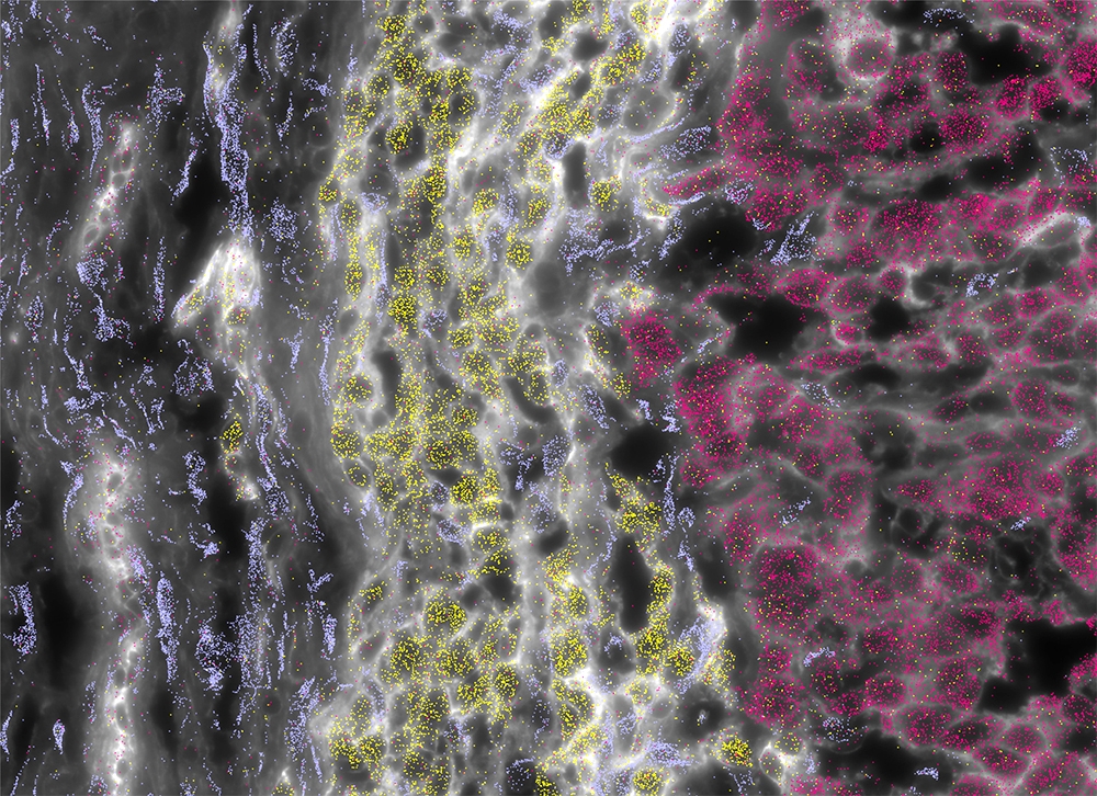 Unique characteristics of a rare liver cancer identified as clinical trial of new treatment begins  