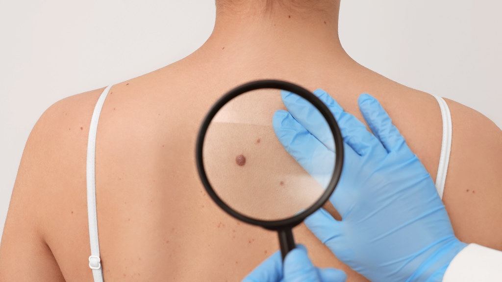 Research helps predict which melanoma patients are most likely to respond to immunotherapy