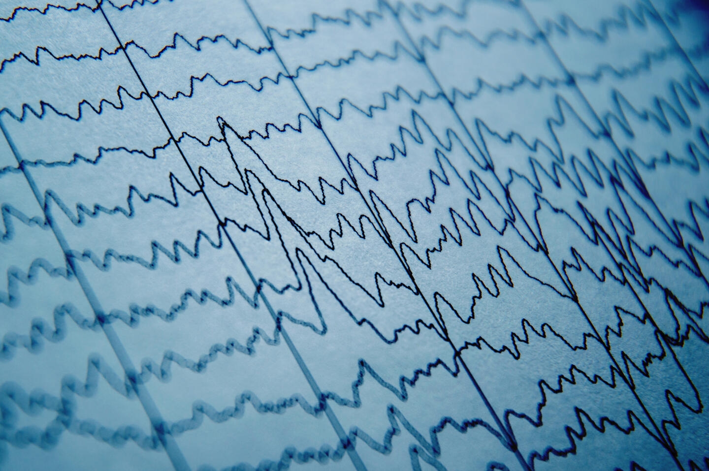 New epilepsy tool could cut misdiagnoses by nearly 70% using routine EEGs