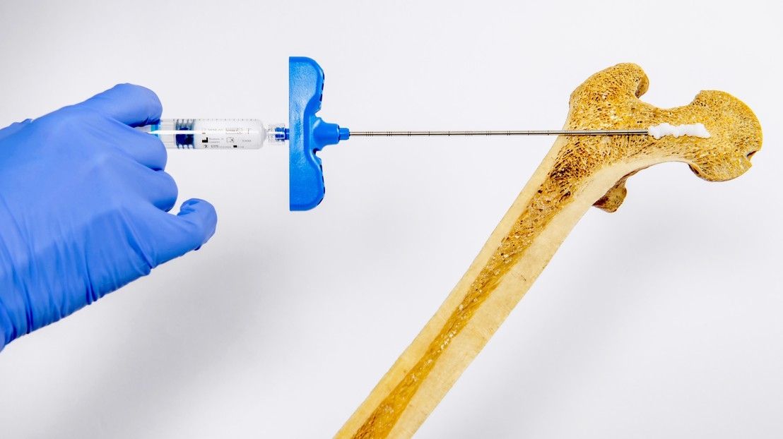 An injectable hydrogel for local bone densification