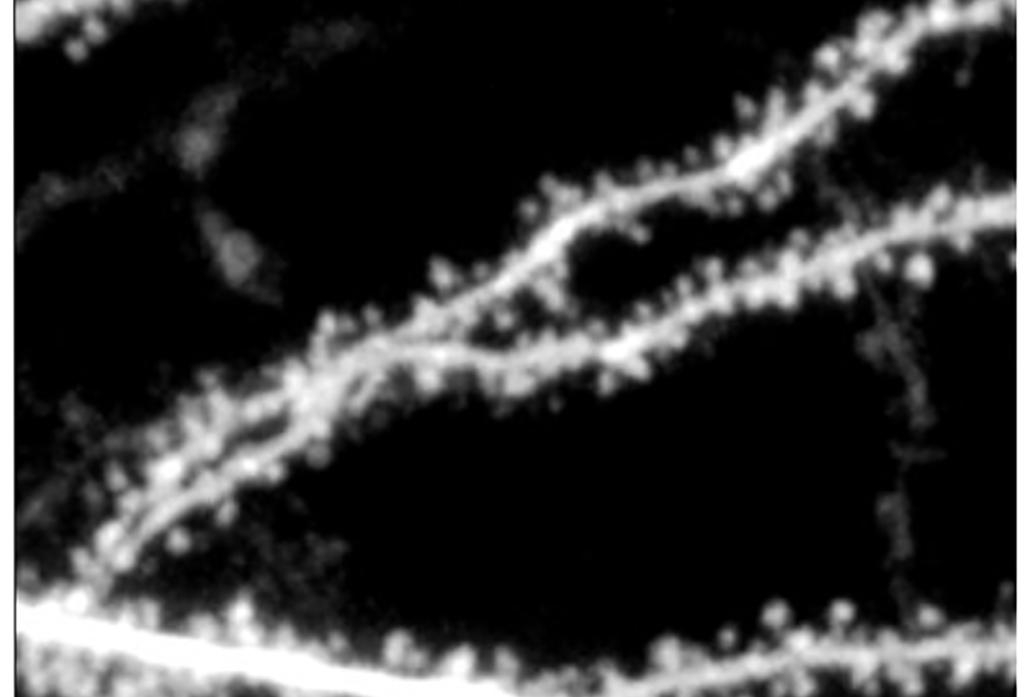 Study suggests new molecular strategy for treating fragile X syndrome