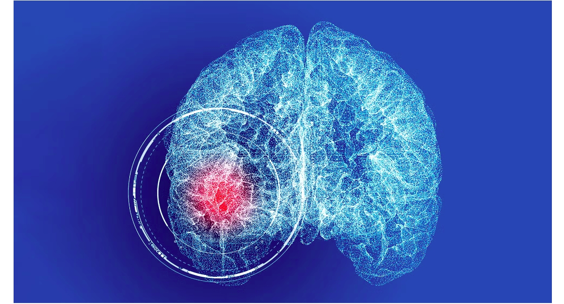 More People Now Die at Home After Stroke Than in Medical Facilities