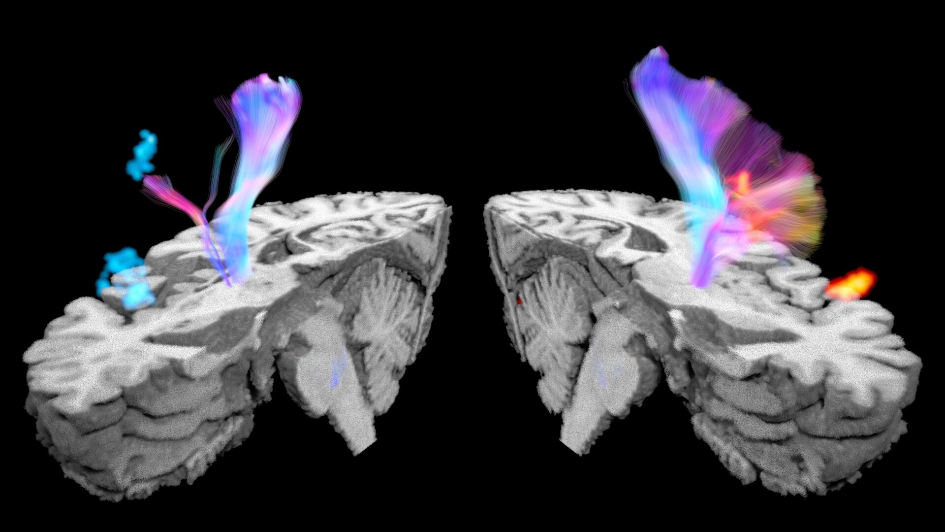 New USC study identifies key brain networks behind post-stroke urinary incontinence