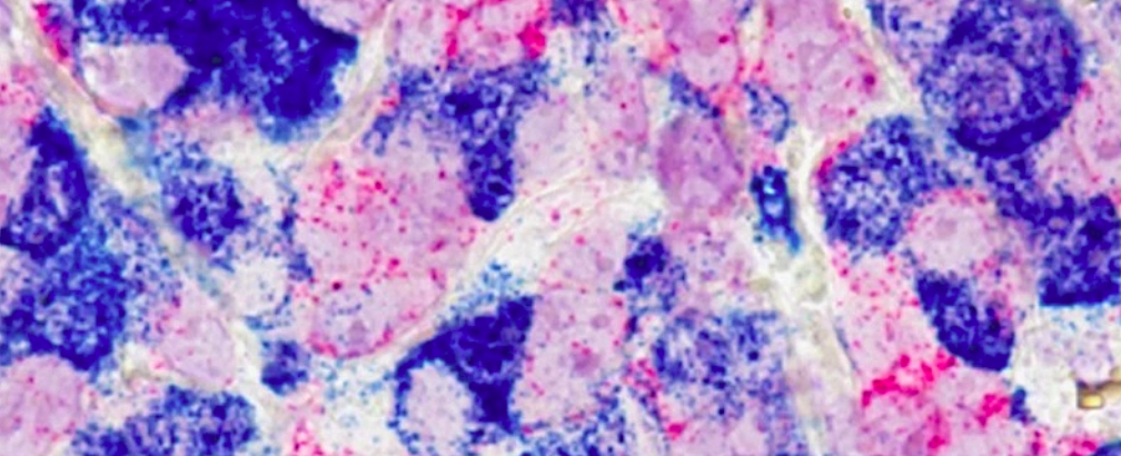 MSU researchers use ‘smart’ bomb therapy to destroy breast cancer