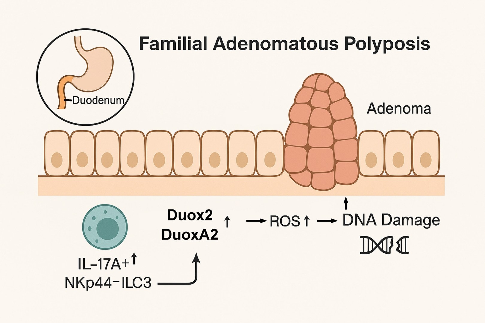 New way to prevent duodenal cancer