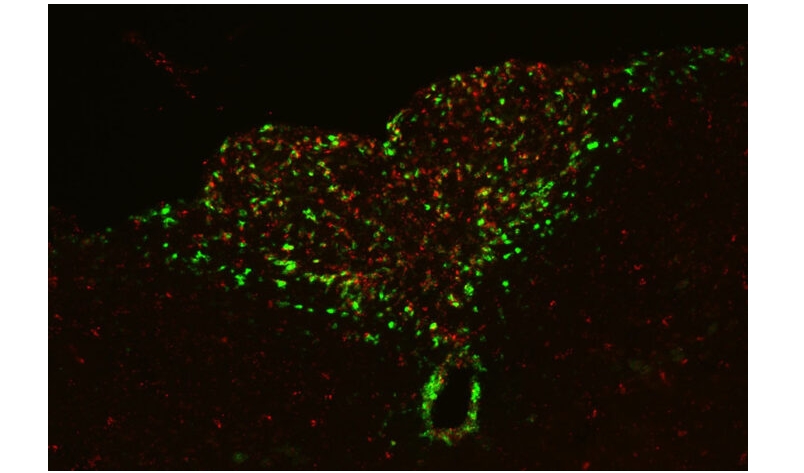 Brain pathway links inflammation to loss of motivation, energy in advanced cancer