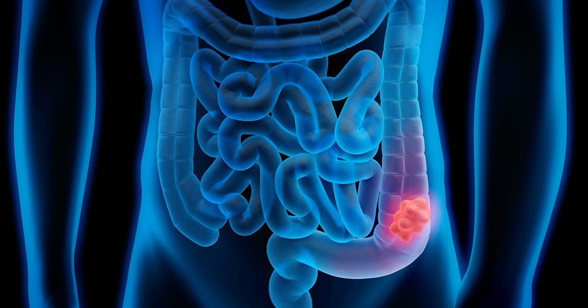 Childhood Exposure to Bacterial Toxin May Be Triggering Colorectal Cancer Epidemic Among the Young