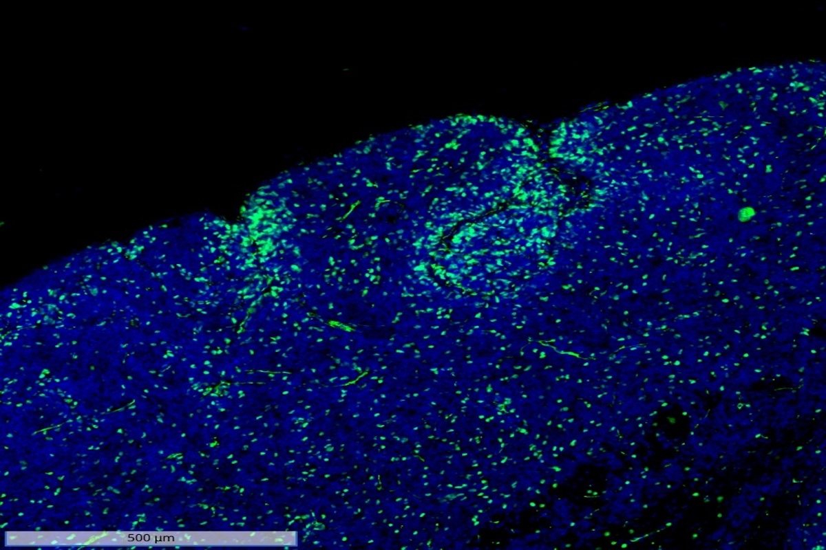 Childhood brain cancer research breakthrough could transform treatment, international study finds