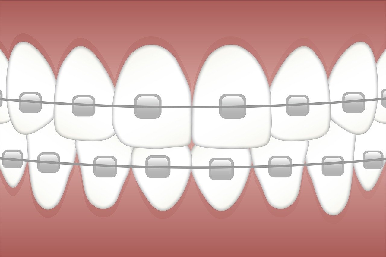Straightening teeth? AI can help